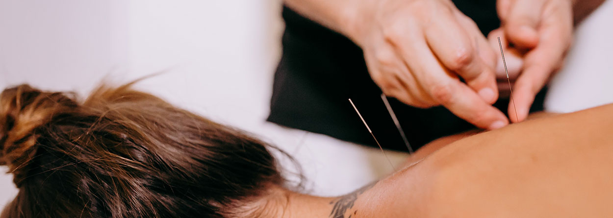 acupuncture therapy in action image of...