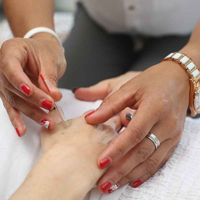 acupuncture treatment in action image of